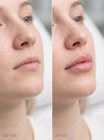 Precision Redefined: Lip Filler Transformation Unveiled
