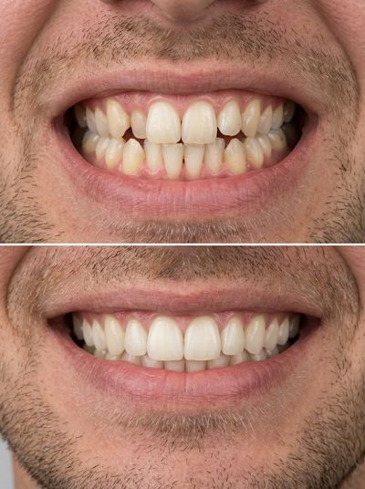 From Crowded to Confident: A Stunning Dental Journey